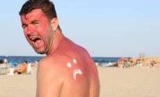 Sunburn in Ireland - ajr_images - Getty Images Pro