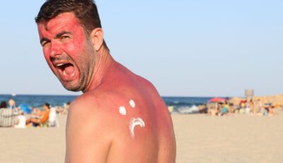 Sunburn in Ireland - ajr_images - Getty Images Pro