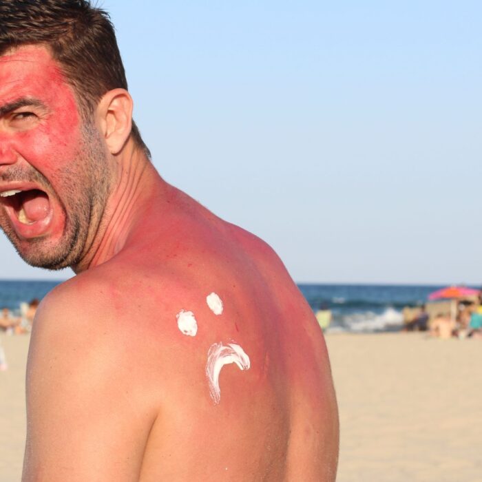 Sunburn in Ireland - ajr_images - Getty Images Pro