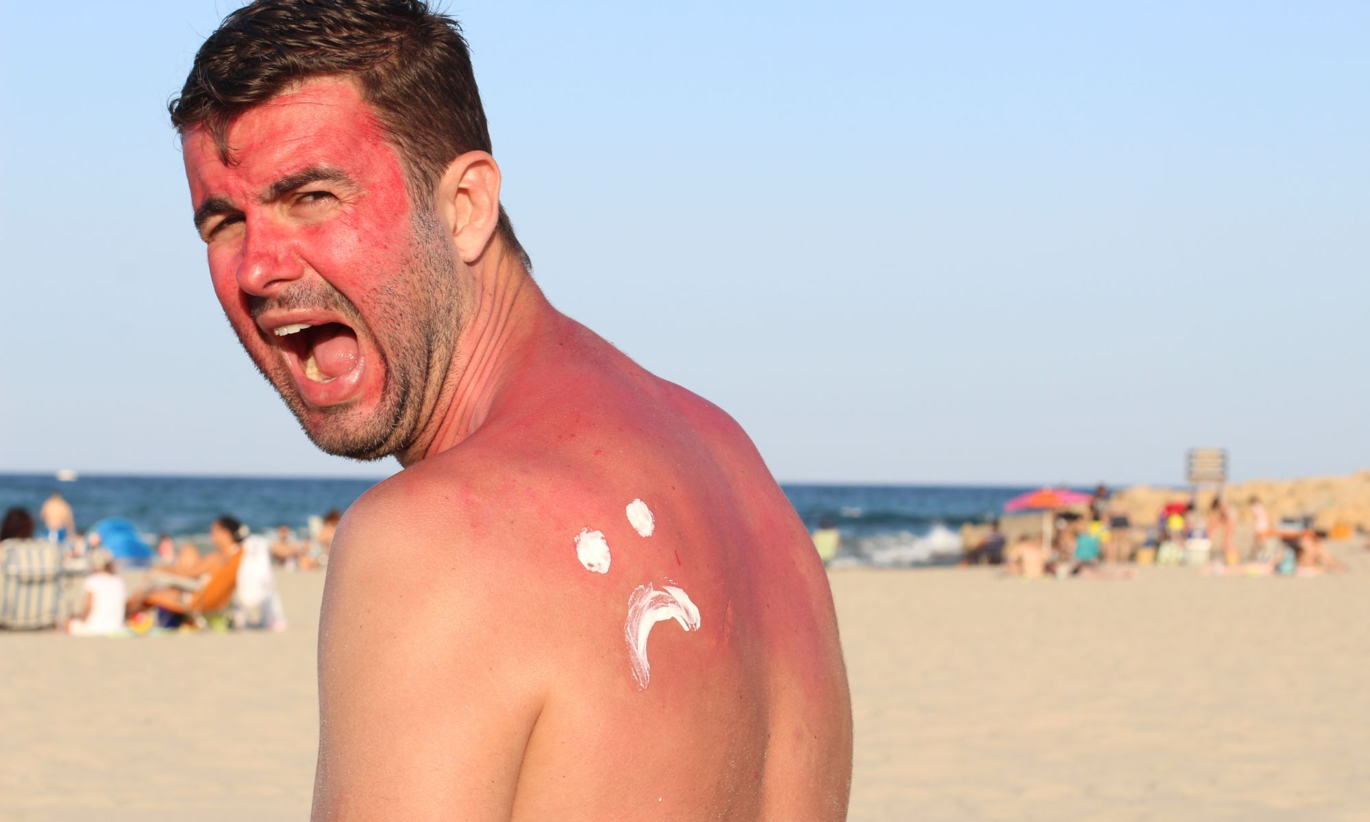 Sunburn in Ireland - ajr_images - Getty Images Pro